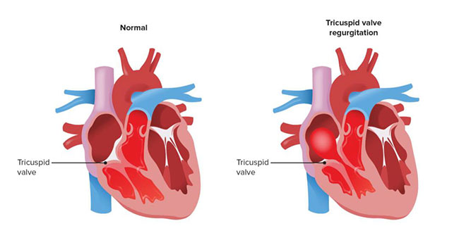 Normal heart versus a heart with tricuspid valve regurgitation illustration