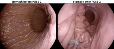 Primary obesity surgery endoluminal-2: before and after - SGH